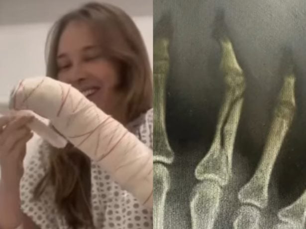 Sammy, ex de Pyong Lee, exibe novos registros da fratura na mão e impressiona
