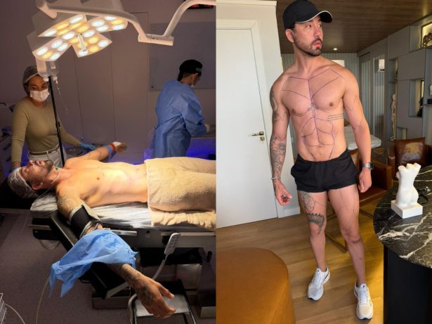 Rico Melquiades realiza 15ª cirurgia plástica para “desenhar” abdômen e pernas