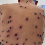 Brasil registra 88 casos de mpox em 2026; São Paulo concentra maioria