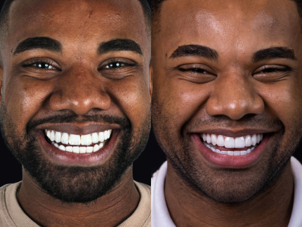 Davi Brito passa por transformação nos dentes após críticas. Veja antes e depois!