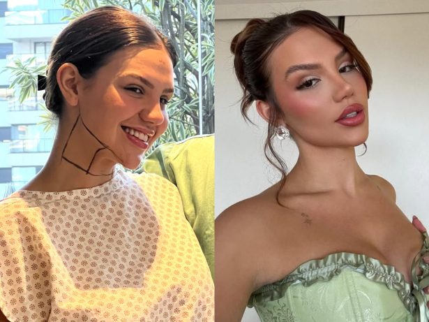 Vivi Wanderley troca próteses de silicone e passa por lipo HD