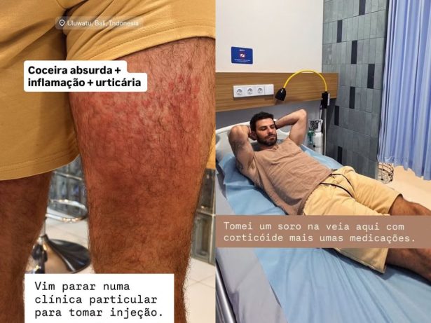Ex-ator global é hospitalizado na Indonésia após sofrer ataque severo de ácaros