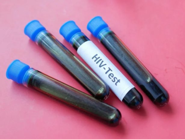 Cientistas registram avanço tido como “impossível” na busca pela cura do HIV. Entenda!