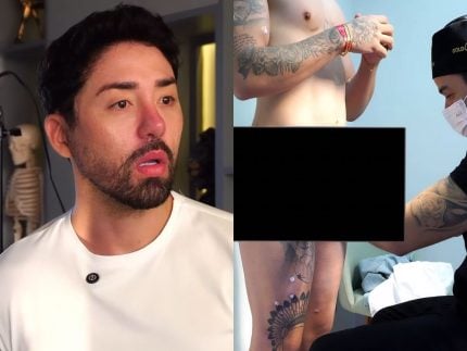 Rico Melquiades faz harmonização peniana