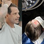Fernando Fernandes renova o visual com transplante capilar sem raspagem