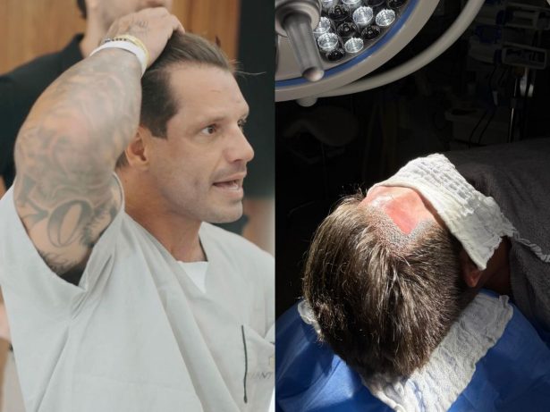 Fernando Fernandes renova o visual com transplante capilar sem raspagem