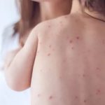 Crescimento de casos de meningite no Brasil reacende alerta: Conheça os sintomas e tratamentos
