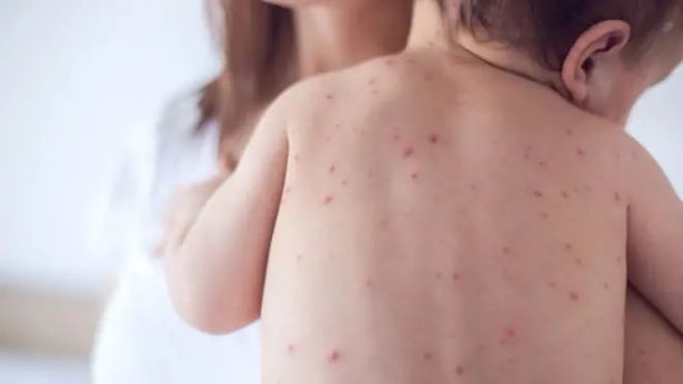 Crescimento de casos de meningite no Brasil reacende alerta: Conheça os sintomas e tratamentos