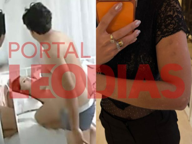 Imagens revelam hematomas de esposa agredida por cantor paraibano