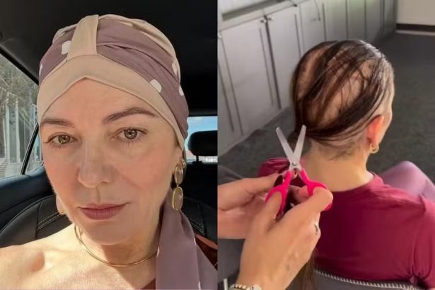 Alopecia areata: especialista explica condição que fez mãe de Lucas Lucco perder cabelo