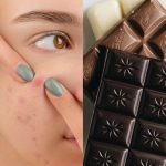Exagerou no chocolate da Páscoa? Saiba como cuidar da pele e driblar a acne