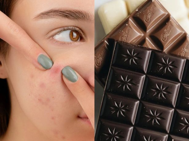 Exagerou no chocolate da Páscoa? Saiba como cuidar da pele e driblar a acne