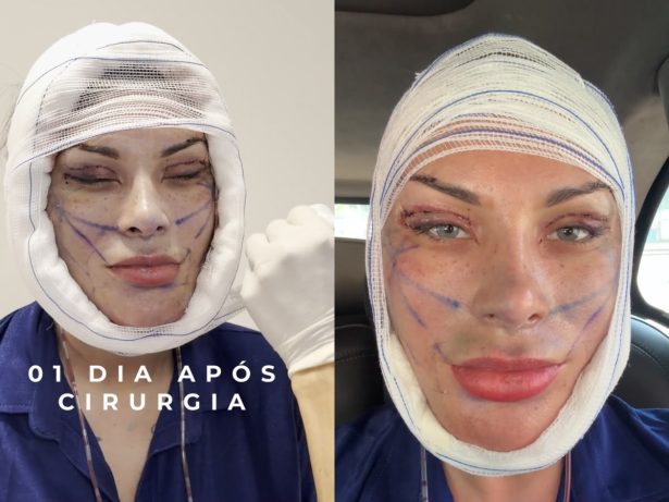 Andressa Urach revela antes e depois de transformação facial; veja o resultado