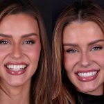 Miss Brasil Universo 2026, Marcella Kozinski renova o sorriso; veja antes e depois