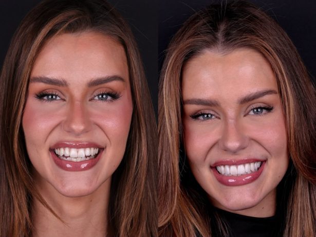 Miss Brasil Universo 2026, Marcella Kozinski renova o sorriso; veja antes e depois