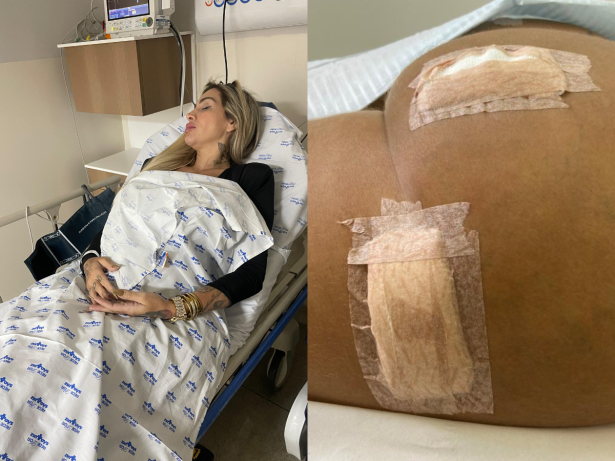 Influenciadora é internada às pressas devido infecção causada por hidrogel no bumbum