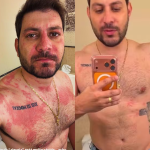 Ex-BBB Caio Afiune é hospitalizado após crise alérgica e relata susto: “Muito ofegante”
