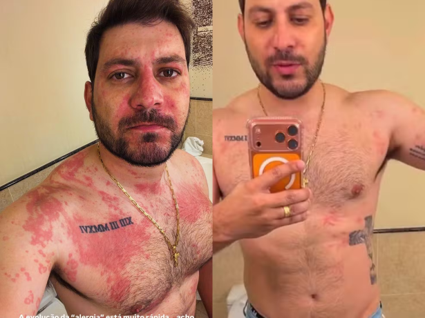 Ex-BBB Caio Afiune é hospitalizado após crise alérgica e relata susto: “Muito ofegante”