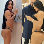Especialista explica uso do PMMA em procedimento de Kamila Simioni para correção no bumbum