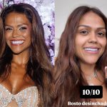 Camila Loures mostra resultado de cirurgia na testa: “Só quem tem sabe o quanto incomoda”