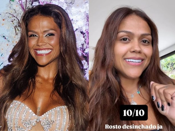 Camila Loures mostra resultado de cirurgia na testa: “Só quem tem sabe o quanto incomoda”