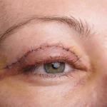 Blefaroplastia: Especialista explica os riscos da cirurgia mais realizada no mundo