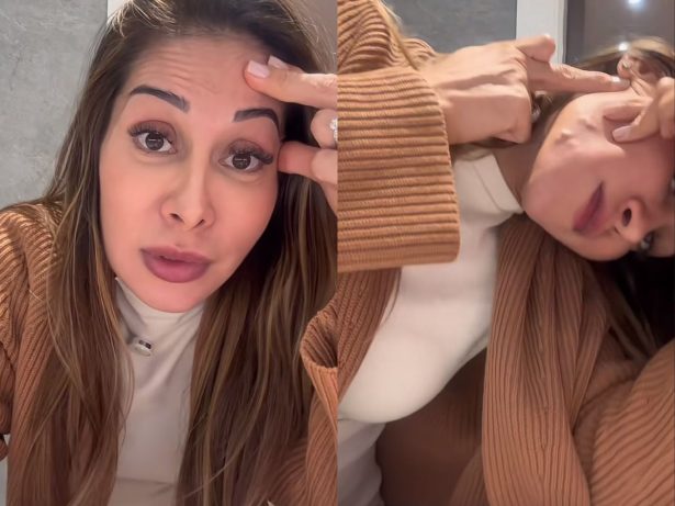 Maíra Cardi choca ao exibir danos de PMMA no rosto: “Tentando rasgar minha pele”