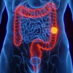 Chico Pinheiro: Médico explica riscos, prevenção e sinais de alerta do câncer de intestino
