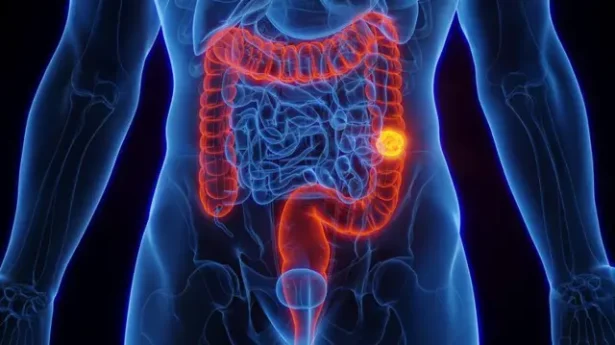 Chico Pinheiro: Médico explica riscos, prevenção e sinais de alerta do câncer de intestino