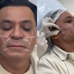 Frank Aguiar faz segunda harmonização facial: “53 com carinha de 33”