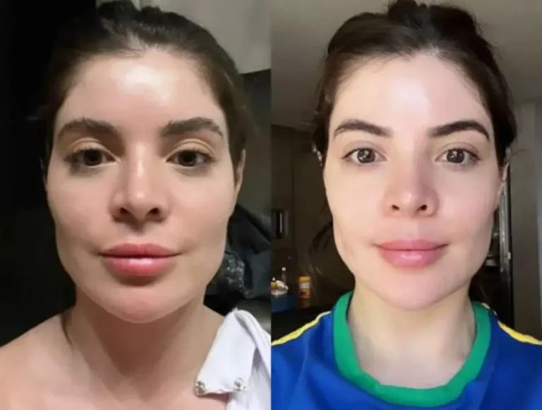 “Desarmonização facial”: Especialista explica nova tendência entre famosos