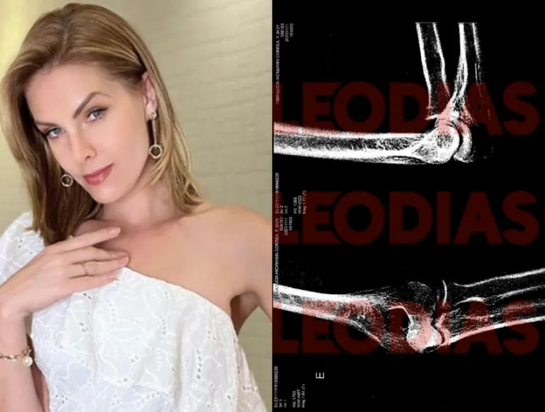 Exame de corpo e delito apontou lesão de natureza leve em braço de Ana Hickmann