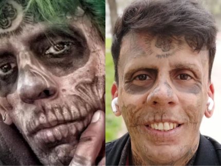 Se arrependeu? Homem mais tatuado do Brasil inicia remoção dos desenhos