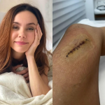 Flávia Monteiro revela cicatriz após cirurgia para retirada de um tumor na perna
