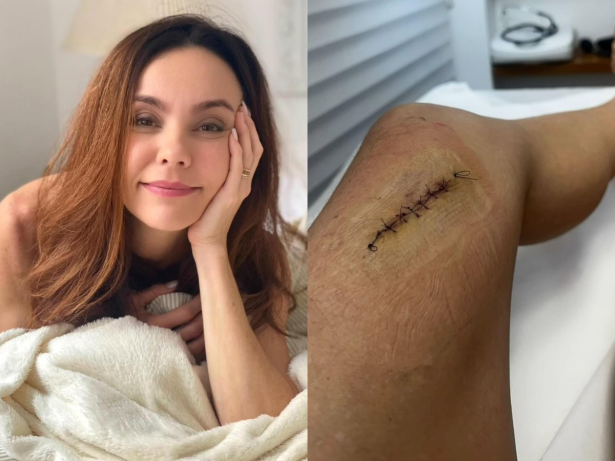 Flávia Monteiro revela cicatriz após cirurgia para retirada de um tumor na perna
