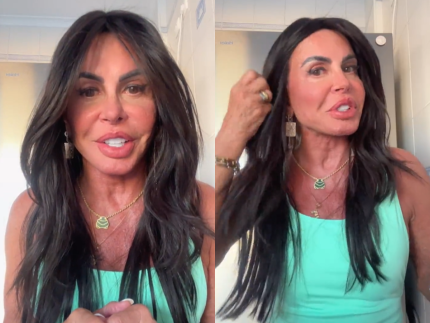 Boca, bochecha e mandíbula: Gretchen exibe resultado de nova harmonização facial
