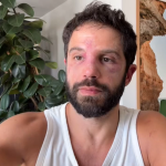 Duda Nagle é barrado em academia com rosto inchado após perder para Popó em luta