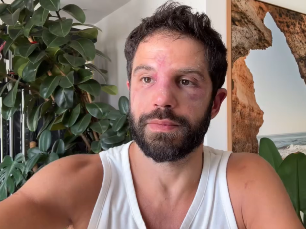 Duda Nagle é barrado em academia com rosto inchado após perder para Popó em luta