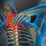 Entenda as distrofias musculares e a importância do diagnóstico precoce