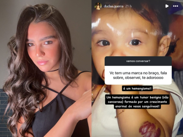 Hemangiomas: especialista explica tumor benigno de Duda Guerra, ex-nora de Huck