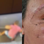 Mulher agredida com 61 socos mostra evolução um mês após cirurgia de reconstrução facial