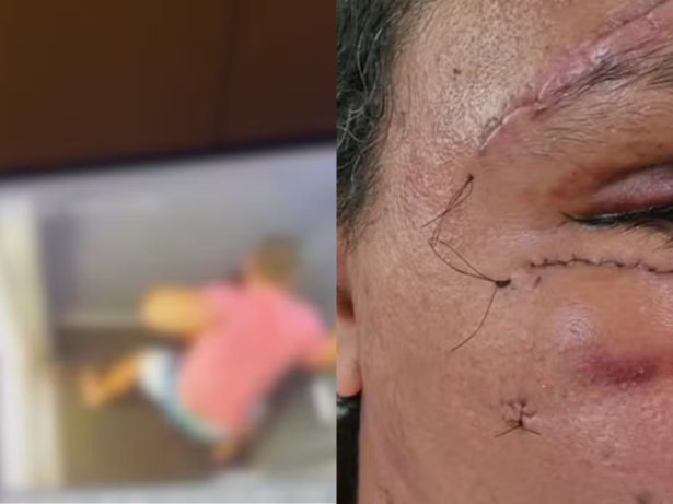 Mulher agredida com 61 socos mostra evolução um mês após cirurgia de reconstrução facial
