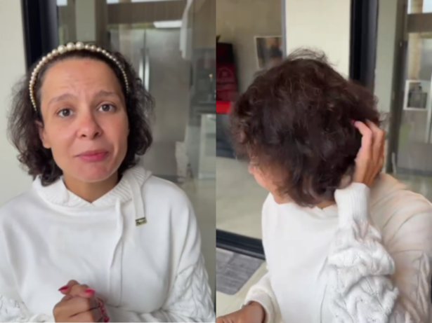Alopecia androgenética: especialista explica condição que fez Maiara perder quase todo o cabelo
