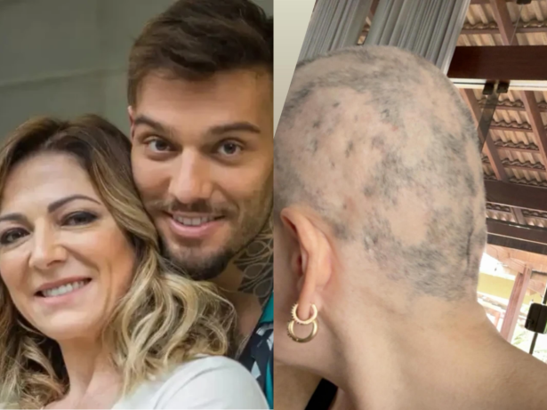 Mãe de Lucas Lucco desabafa sobre alopecia: “Mesmo raspando, as falhas ainda ficam visíveis”