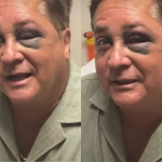 Leonardo aparece com olho roxo e deixa fãs em choque; entenda o motivo do hematoma