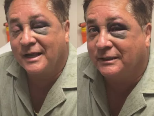 Leonardo aparece com olho roxo e deixa fãs em choque; entenda o motivo do hematoma