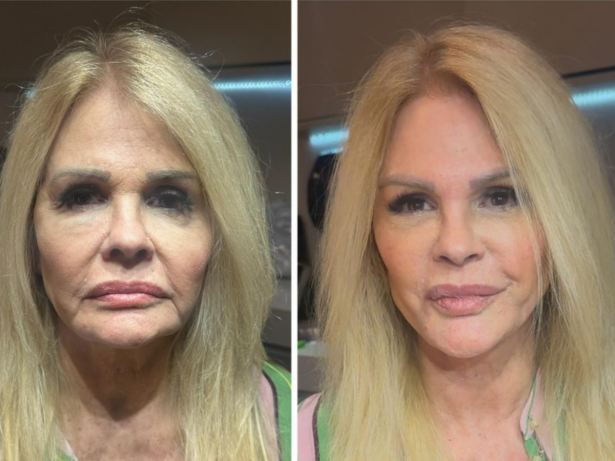 Monique Evans avalia nova harmonização facial: “Rejuvenesci não sei quantos anos”