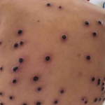 Mpox no Brasil: Infectologista explica o que é a doença, sintomas e como acontece a transmissão