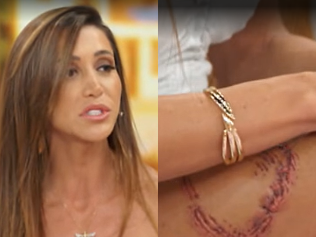 Mulher atacada por tubarão em Fernando de Noronha relembra o momento do incidente