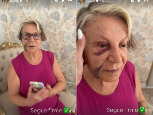 Poliana Rocha conta como está a mãe, de 84 anos, após queda: “Roxo vai demorar a sair”